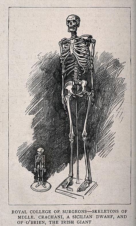 Skeletons of a male giant and a female dwarf, displayed at the Royal College of Surgeons.